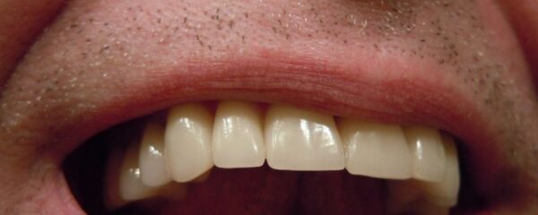Gros plan sur une bouche souriante dotée d'un appareil dentaire