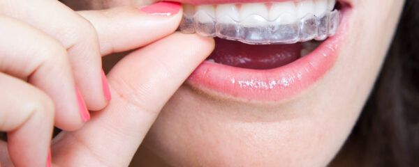 Orthodontie adulte