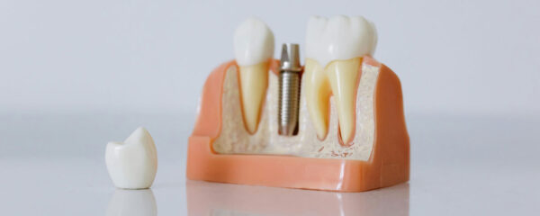 implants