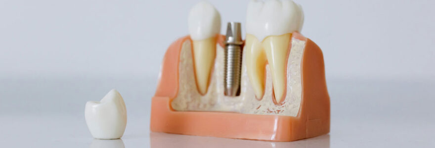 implants